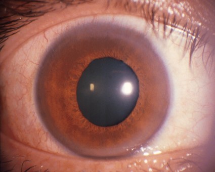 cataract1