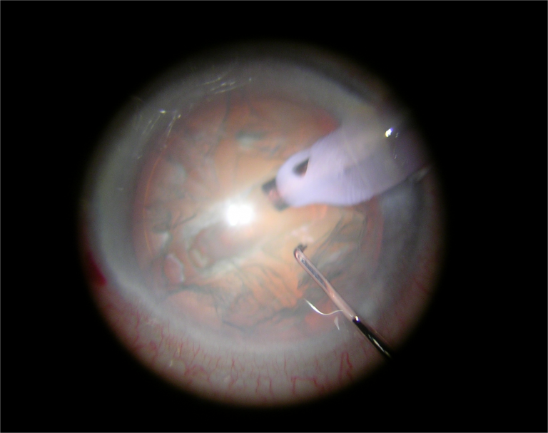 Cataract Eye Surgery Dr Goh Eye