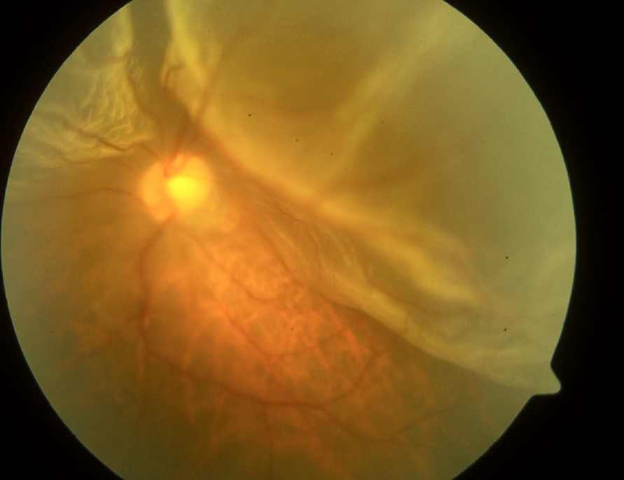 retina1